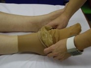 Konzervativní léčba bandážováním