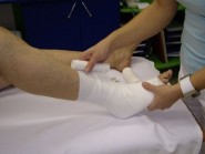 Konzervativní léčba bandážováním