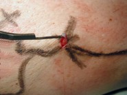 Operace varixů technikou CHIVA