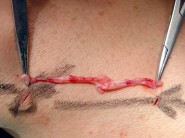 Operace varixů technikou CHIVA