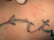 Operace varixů technikou CHIVA