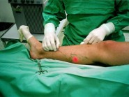 Endovenosní laserová operace EVLT