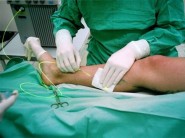 Endovenosní laserová operace EVLT