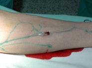 Radiofrekvenční endoluminální ablace žíly RFC VNUS Closure