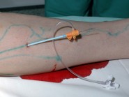 Radiofrekvenční endoluminální ablace žíly RFC VNUS Closure