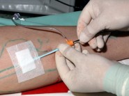 Radiofrekvenční endoluminální ablace žíly RFC VNUS Closure